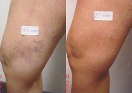 Can Varicose Veins Go Away With Exercise